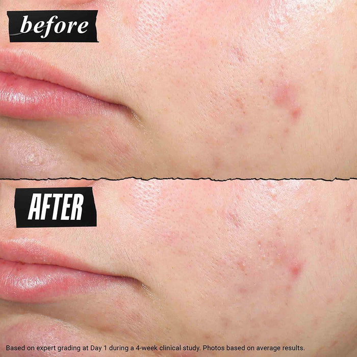 Kiehl's Truly Targeted Blemish - Clearing Solution